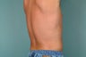 Smart Lipo