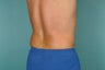 Smart Lipo