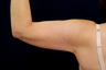 Liposuction of the Upper Arms