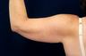 Liposuction of the Upper Arms