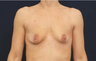 Breast Augmentation with Lift