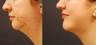 Chin Implant and Liposuction