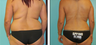 Liposuction Before & After