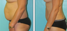 Liposuction Before & After
