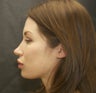 27 year old female with upper and lower lip implants