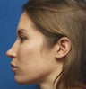 27 year old female with upper and lower lip implants