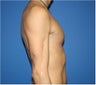 Pectoral Augmentation, Pec Implants