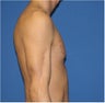 Pectoral Augmentation, Pec Implants