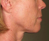 Ulthera