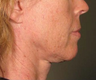 Ulthera