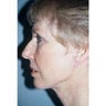Neck Lift