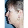 Neck Lift