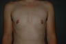 FTM top surgery. Keyhole approach with areola resizing and nipple reduction.
