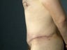 Male Abdominoplasty