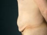 Male Abdominoplasty