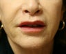 Four weeks after lip lift