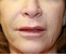 Four weeks after lip lift