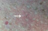 Mole Removal and Biopsy of Moles