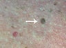 Mole Removal and Biopsy of Moles