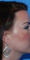 Caucasian Female Treated for Crows Feet