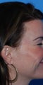 Caucasian Female Treated for Crows Feet