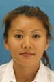 Otoplasty