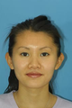 Otoplasty