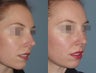 Female Primary Rhinoplasty
