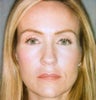 Botox