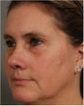 52 year old female with sun damaged skin