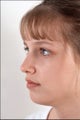 Rhinoplasty