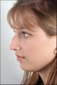 Rhinoplasty
