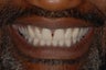 This male patient had replacement of all his teeth with full denture in the top jaw and implant bridge in the bottom jaw.
