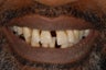 This male patient had replacement of all his teeth with full denture in the top jaw and implant bridge in the bottom jaw.