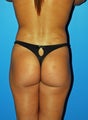 brazilian butt lift