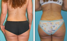 Brazilian Butt Lift Before & After
