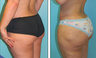 Brazilian Butt Lift Before & After