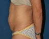 Vaser Liposuction of the Abdomen