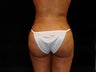 Buttocks Augmentation by Fat Grafting