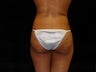 Buttocks Augmentation by Fat Grafting
