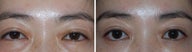 Before and after Asian Blepharoplasty with Arcus Release and Fat Grafting