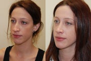 Rhinoplasty Surgery with left spreader graft. 7-months post-op.