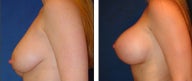 Breast Lift- Mastopexy