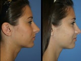 Rhinoplasty