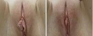 Labiaplasty