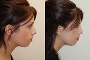 Rhinoplasty Surgery. 2 months post-op