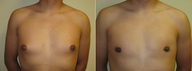 Male Breast Reduction