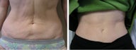 Thermage Skin Tightening for the Abdomen