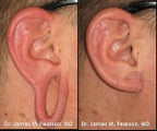Gauged Earlobe Repair