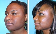 Nose Job- Rhinoplasty